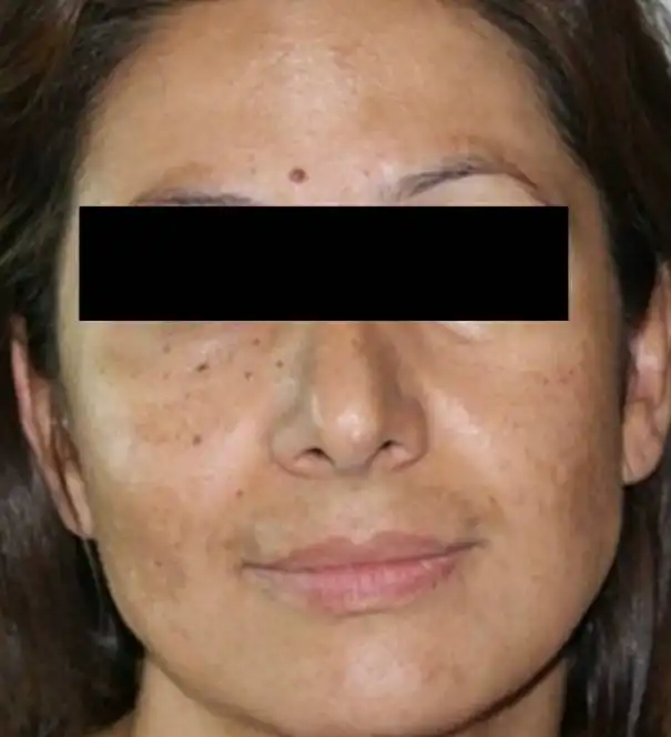 Acne Scar Treatment, Dark spot treatment, Acne Mark