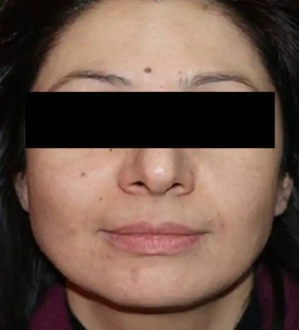 Acne Scar Treatment, Dark spot treatment, Acne Mark