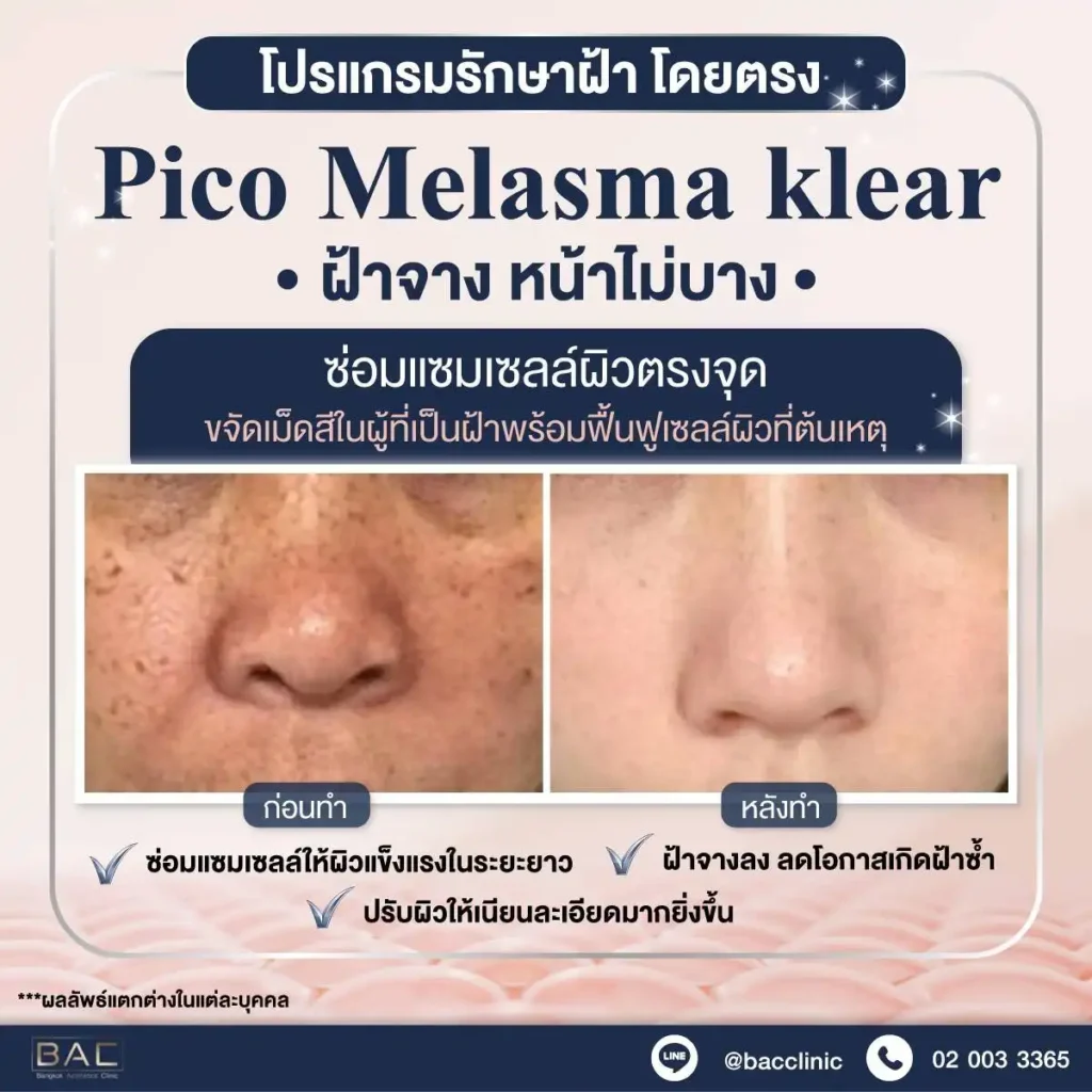 Acne Scar Treatment, Dark spot treatment, Acne Mark