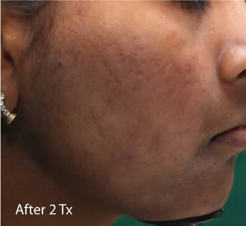 Acne Scar Treatment, Dark spot treatment, Acne Mark