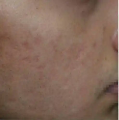 Acne Scar Treatment, Dark spot treatment, Acne Mark