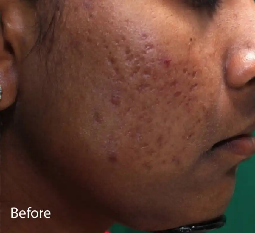 Acne Scar Treatment, Dark spot treatment, Acne Mark