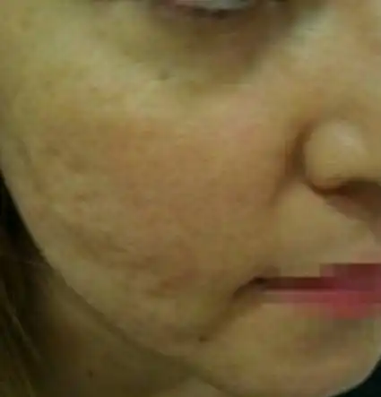 Acne Scar Treatment, Dark spot treatment, Acne Mark