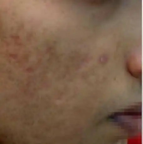 Acne Scar Treatment, Dark spot treatment, Acne Mark