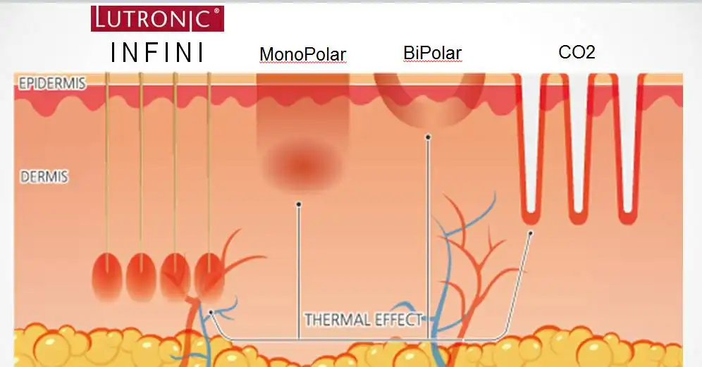 Acne Scar Treatment, Dark spot treatment, Acne Mark