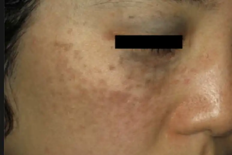 Acne Scar Treatment, Dark spot treatment, Acne Mark