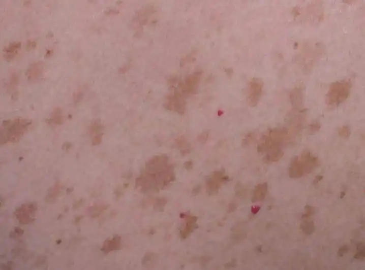 (Ephelides (Freckles) — Dermatology Advisor, n.d.) 