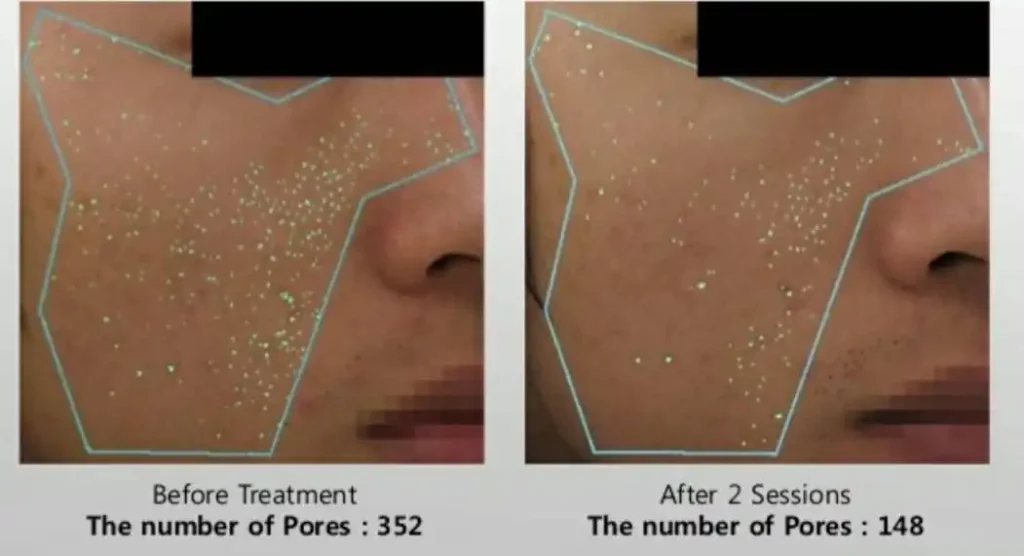 Acne Scar Treatment, Dark spot treatment, Acne Mark