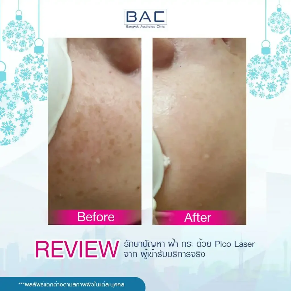 Acne Scar Treatment, Dark spot treatment, Acne Mark