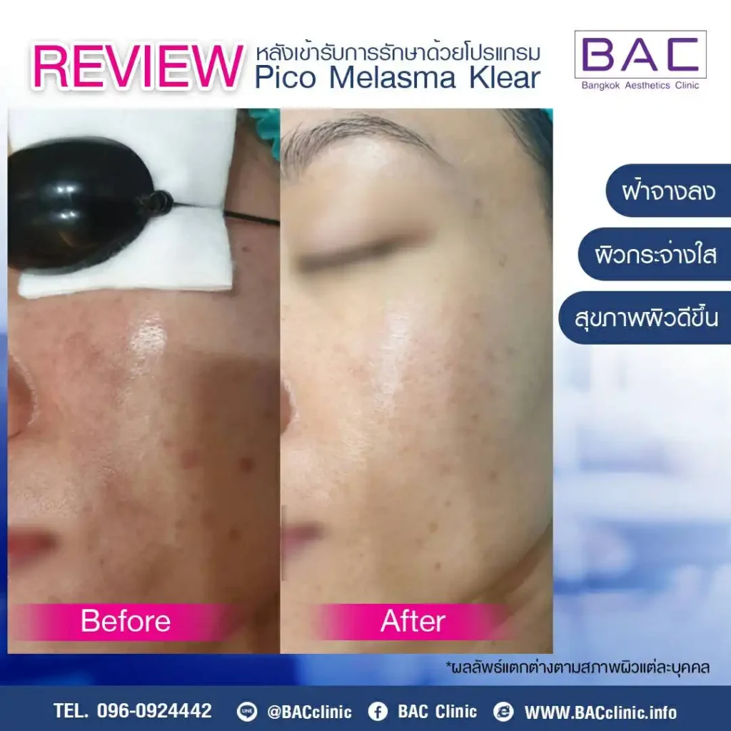 Acne Scar Treatment, Dark spot treatment, Acne Mark