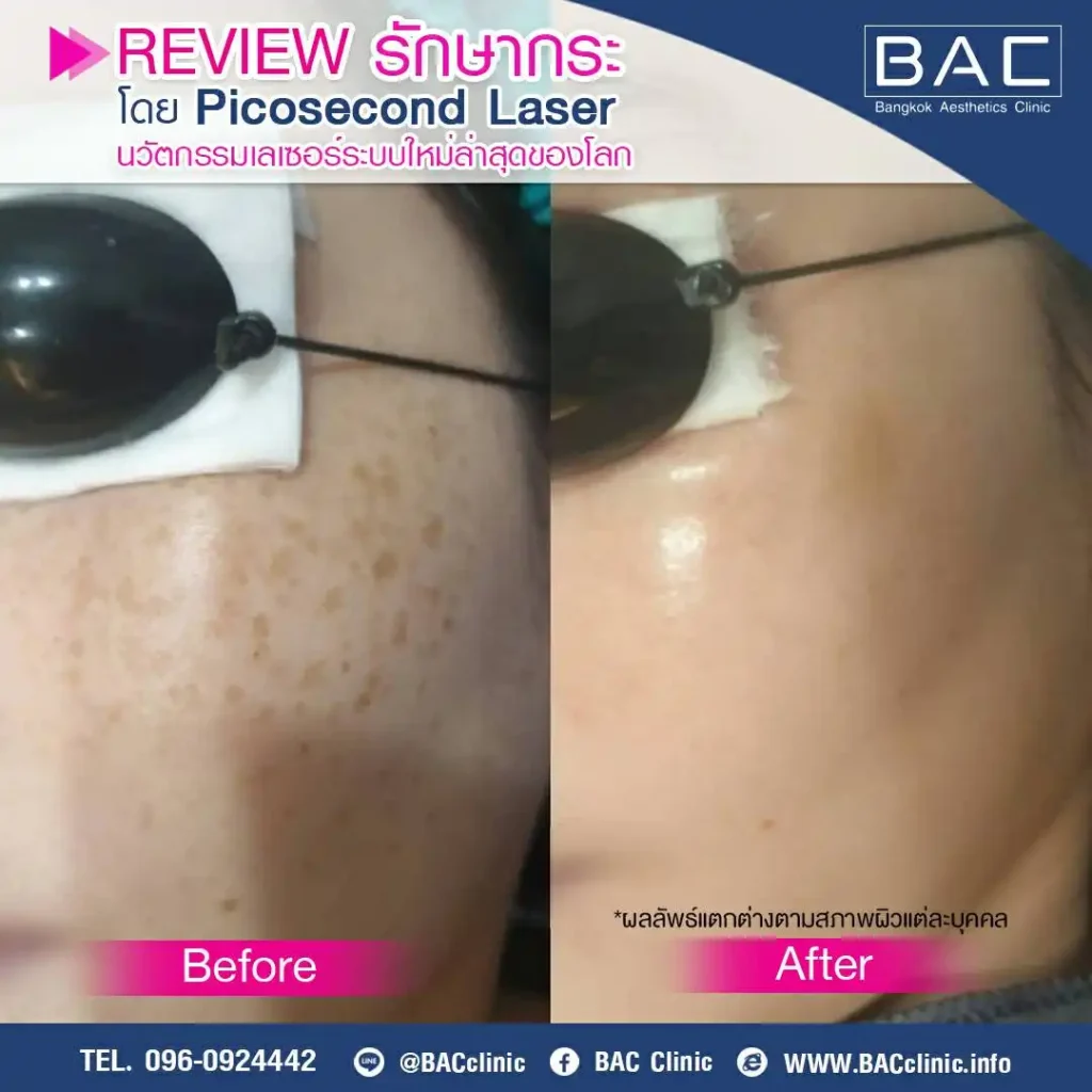 Acne Scar Treatment, Dark spot treatment, Acne Mark