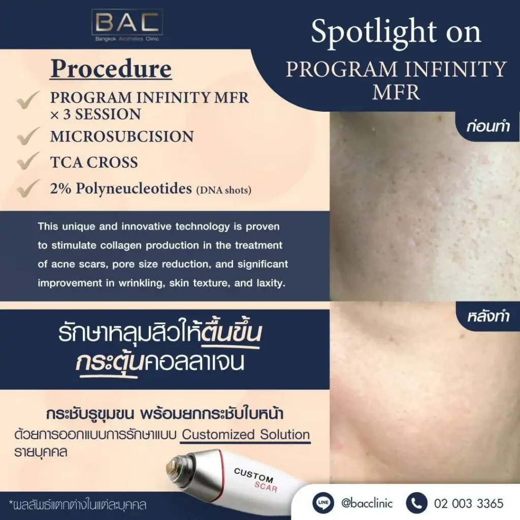 Acne Scar Treatment, Dark spot treatment, Acne Mark