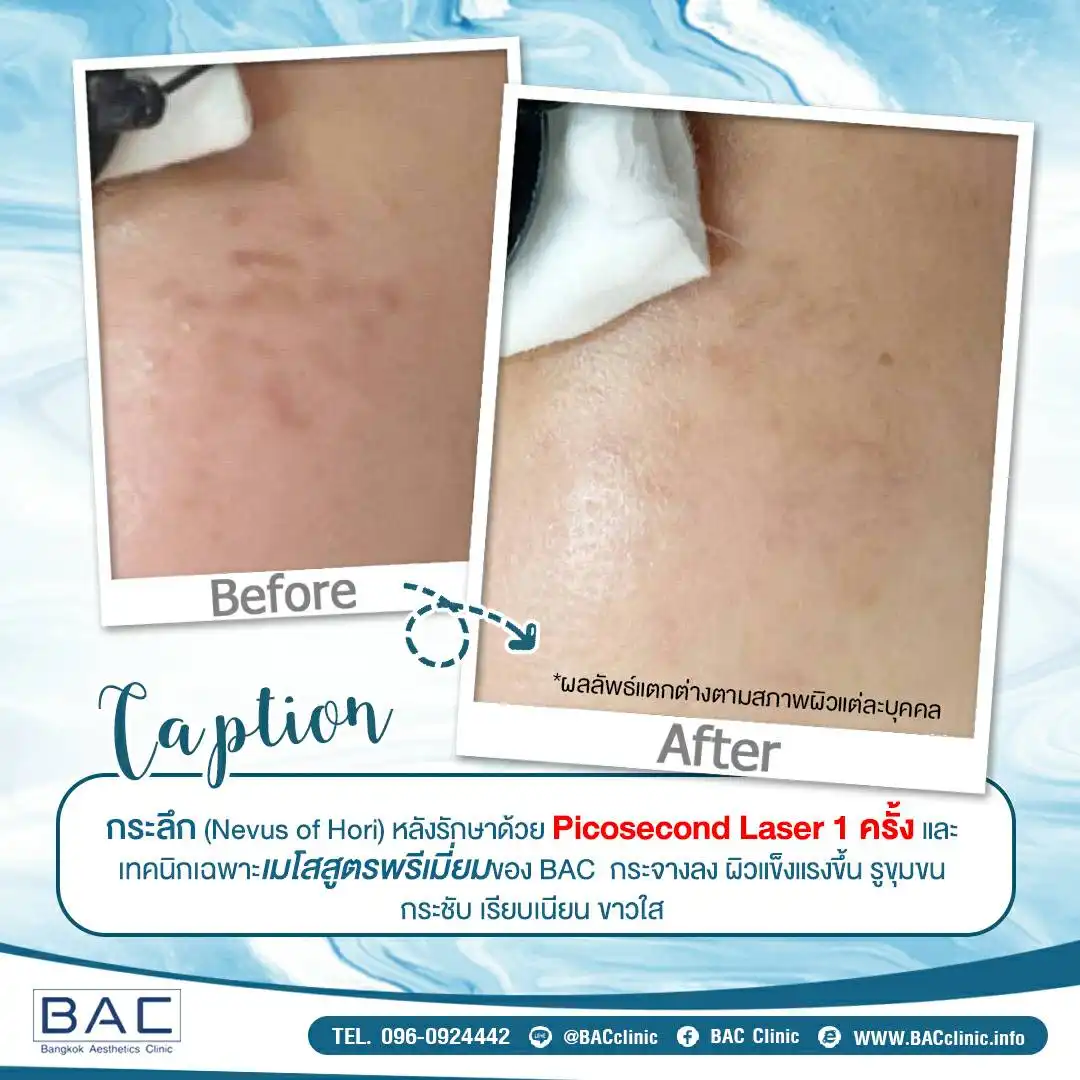 Acne Scar Treatment, Dark spot treatment, Acne Mark