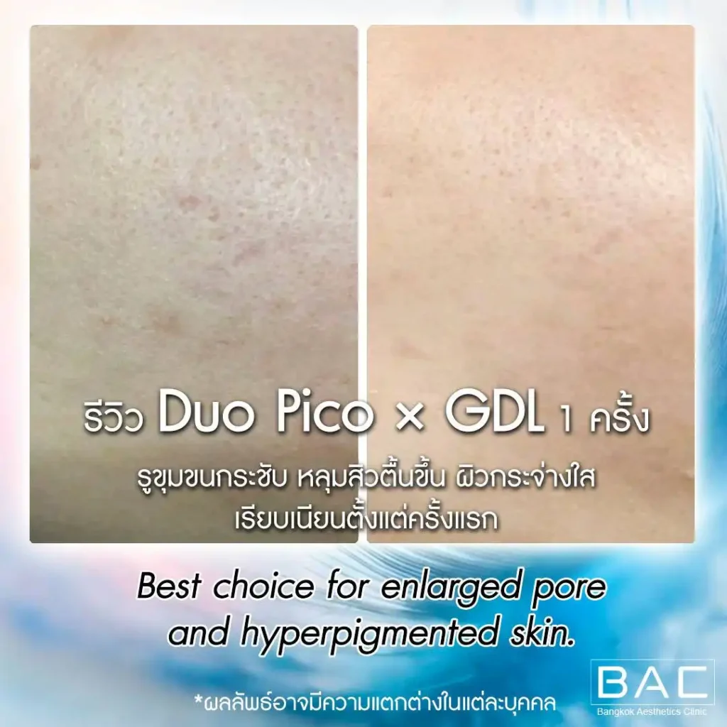 Acne Scar Treatment, Dark spot treatment, Acne Mark