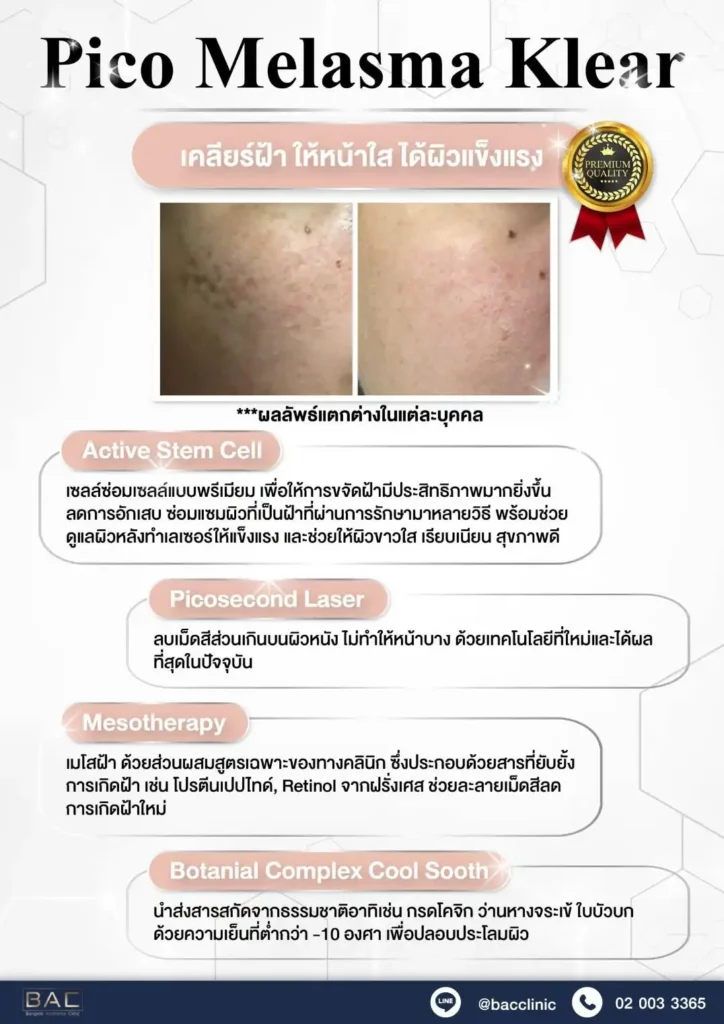 Acne Scar Treatment, Dark spot treatment, Acne Mark