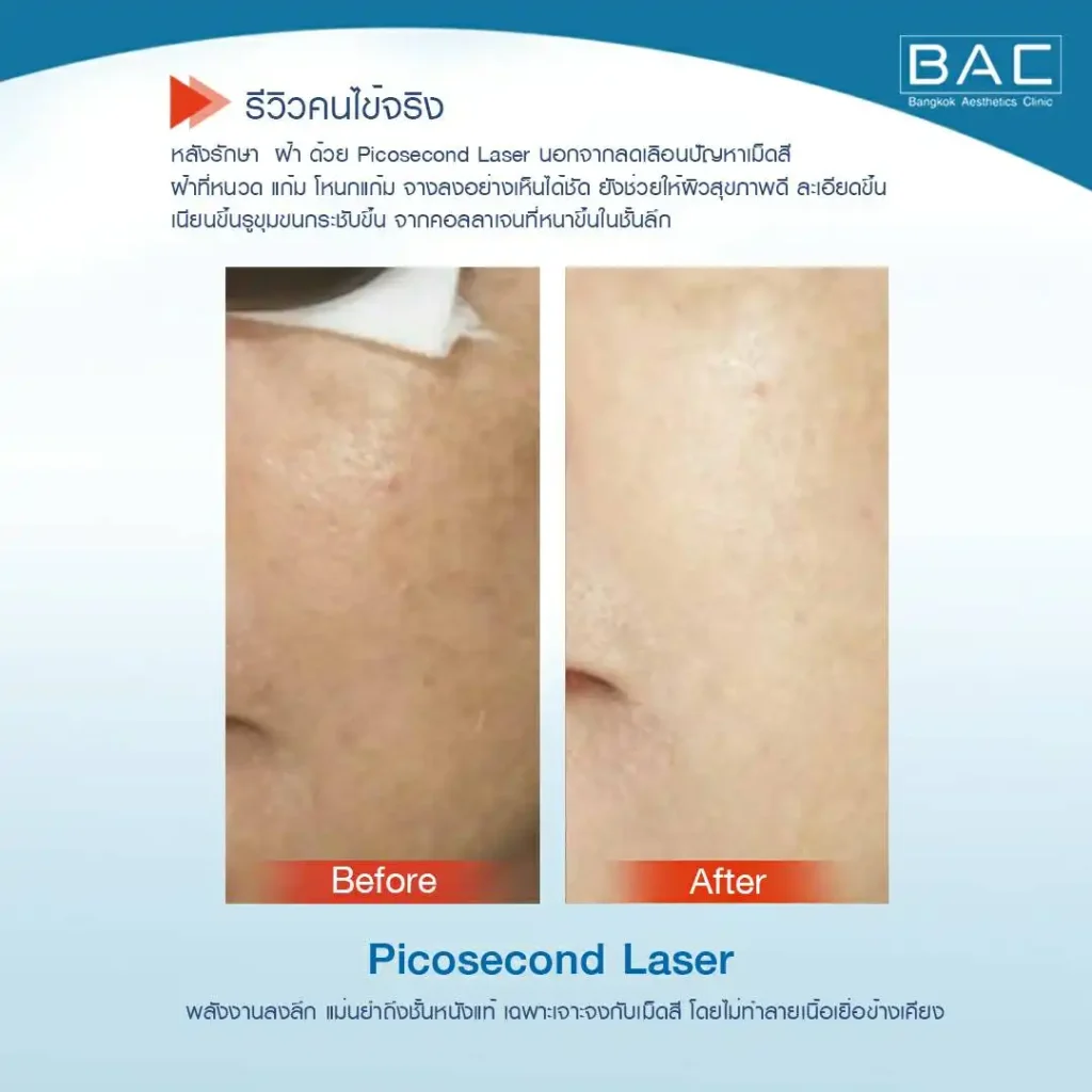 Acne Scar Treatment, Dark spot treatment, Acne Mark