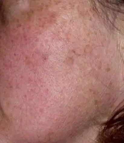 Acne Scar Treatment, Dark spot treatment, Acne Mark