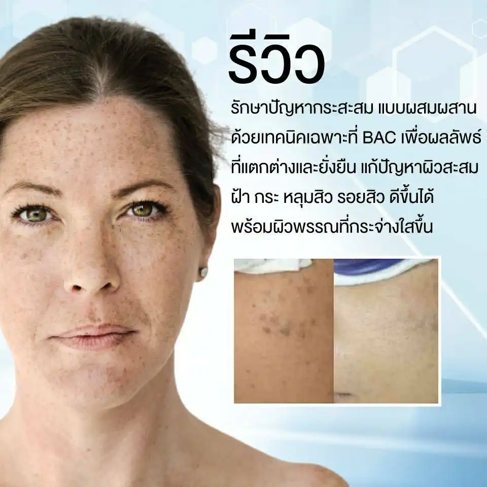 Acne Scar Treatment, Dark spot treatment, Acne Mark