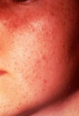 Blackheads (Open Comedones): Small bumps with a visible black center. 