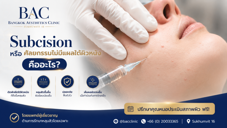 Subcision ตัดผังผืดหลุมสิวคืออะไร?