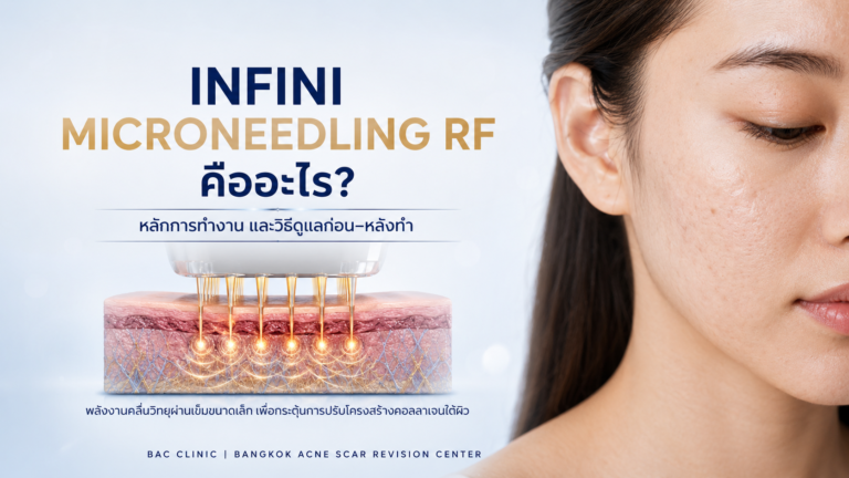 รักษาหลุมสิวที่ไหนดี คลินิกรักษาหลุมสิวที่จริงใจ-BAC Clinic