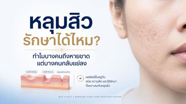 หลุมสิวรักษาได้ไหม? ทำไมบางคนถึงหายขาด แต่บางคนกลับแย่ลง
