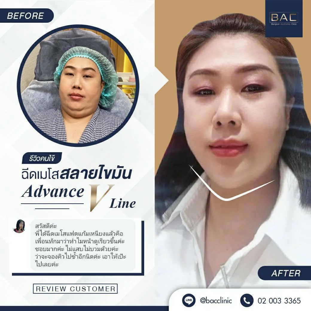 Lipolysis injection treatment review at BAC Clinic Bangkok