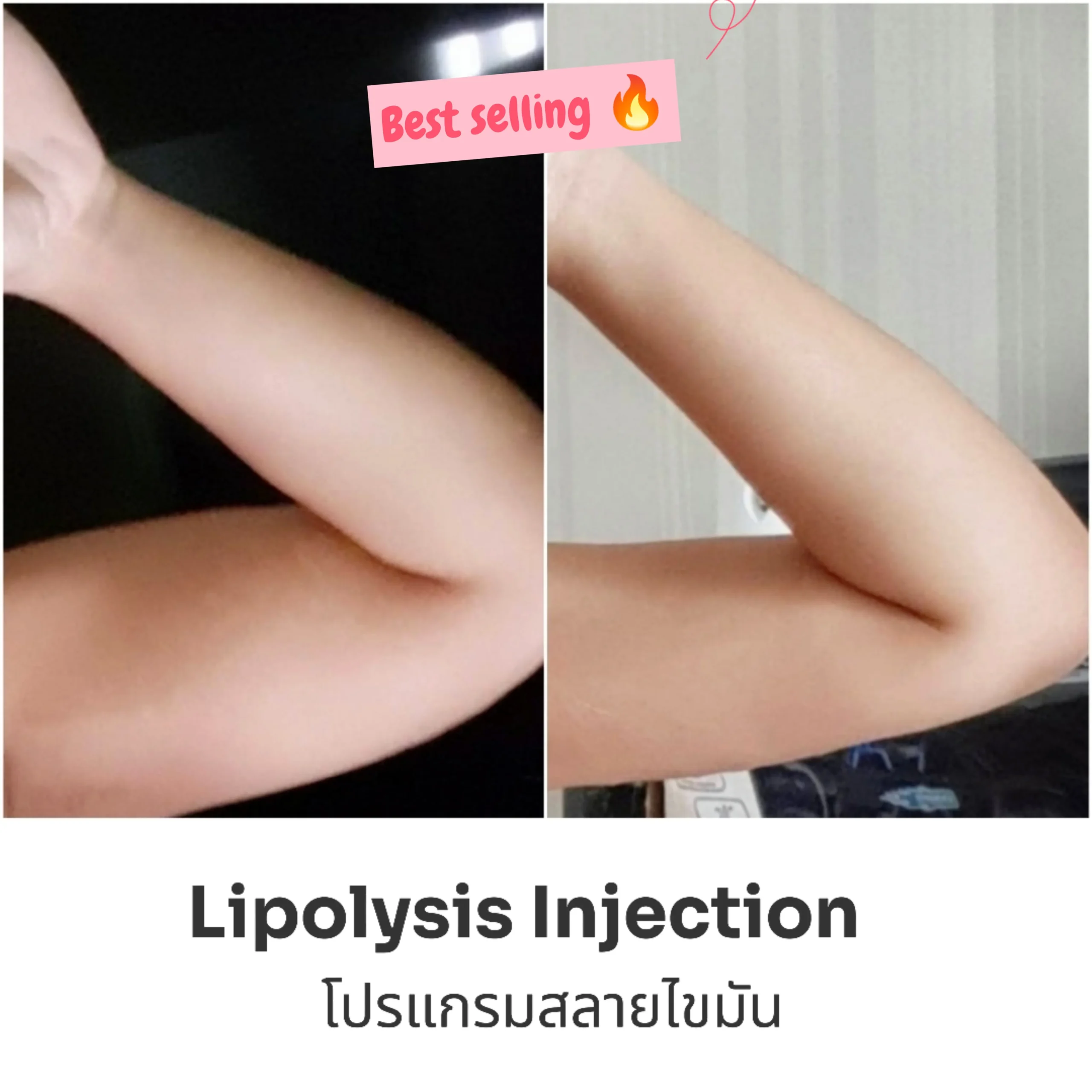Lipolysis injection face and body contouring review at BAC Clinic Bangkok