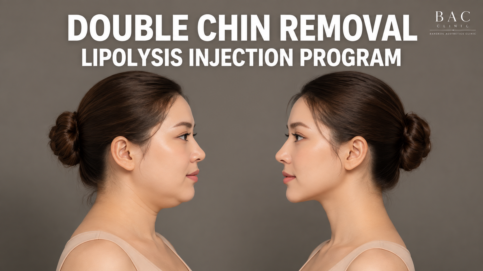 lypolysis injection