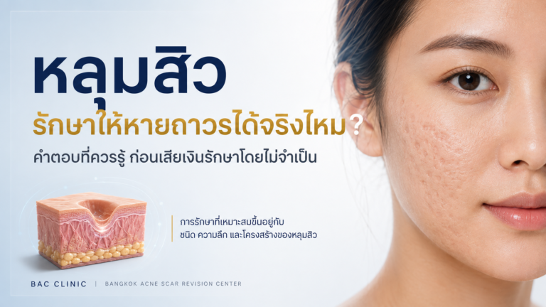 หลุมสิวสามารถรักษาให้หายถาวรได้จริงไหม?