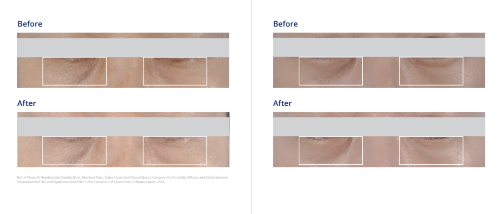 Clinical Study - REJURAN® i