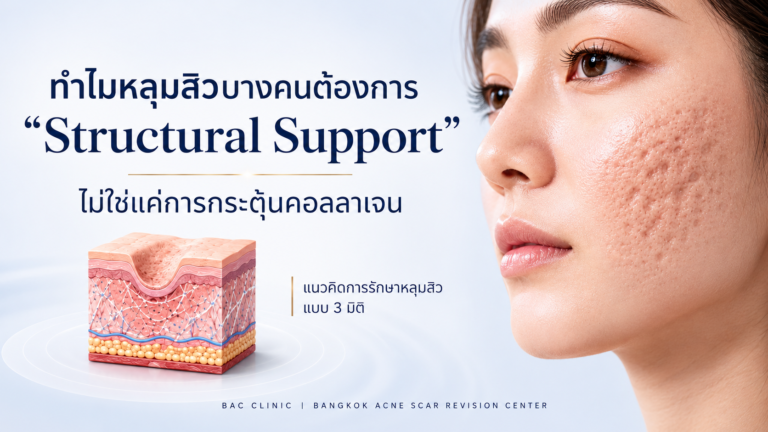 ทำไมหลุมสิวบางคนต้องการ “Structural Support” ไม่ใช่แค่การกระตุ้นคอลลาเจน