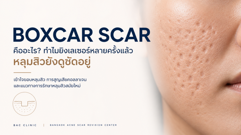 Boxcar Scar คืออะไร? ทำไมบางคนยิงเลเซอร์หลายครั้งแล้ว หลุมสิวยังดูชัดอยู่