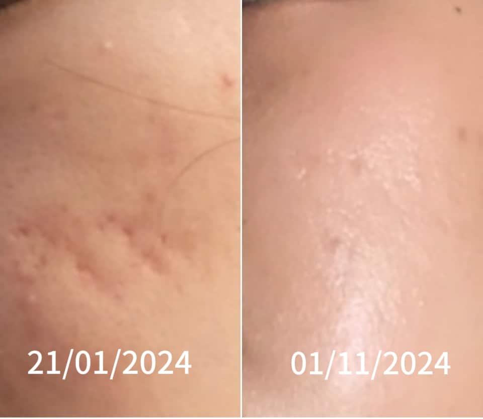 Rejuran acne scar treatment Bangkok at BAC Clinic