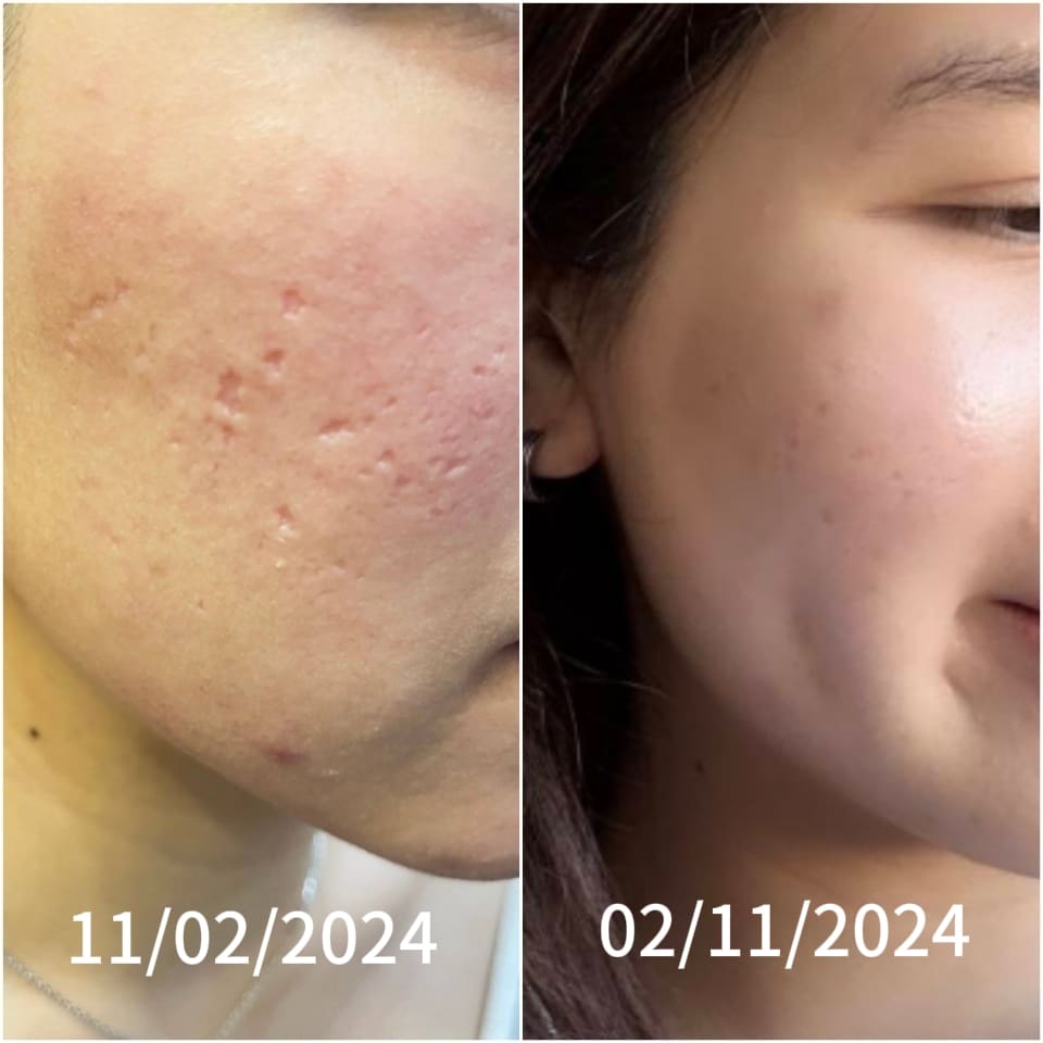 Rejuran S acne scar treatment at BAC Clinic Bangkok