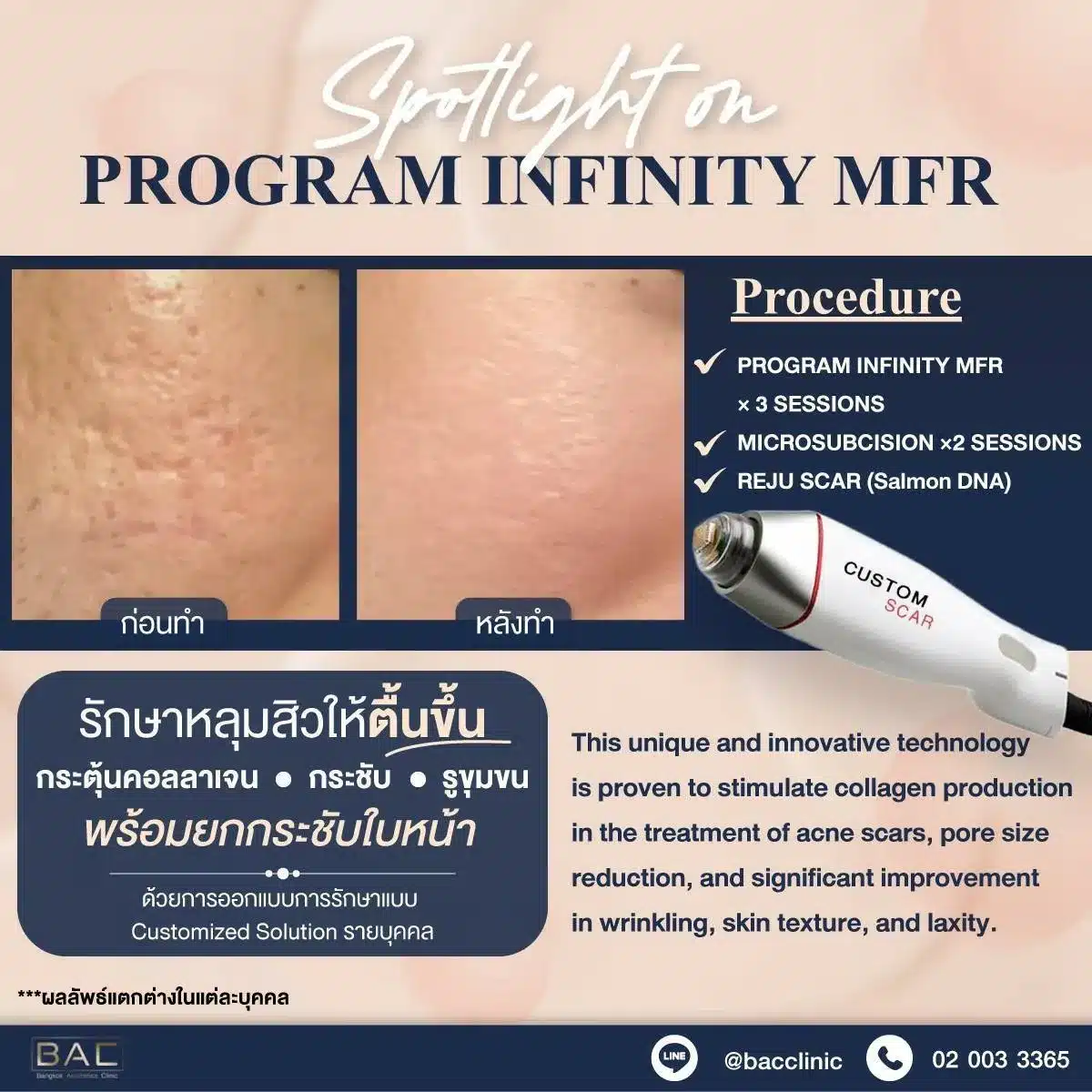 Rejuran acne scar treatment Bangkok