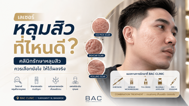 เลเซอร์หลุมสิวที่ไหนดี? วิธีเลือกคลินิกรักษาหลุมสิวให้ตรงชนิดเห็นผลจริง