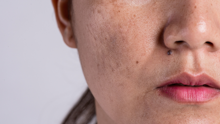 Effective Melasma, Freckle & Dark Spot Treatment Bangkok