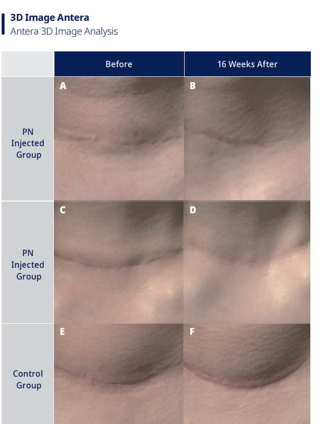 rejuran acne scar treatment bangkok
