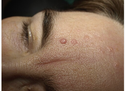 ต่อมไขมันโต Sebaceous Hyperplasia เป็นตุ่มสีเนื้อหรือเหลืองอ่อนและอาจมีรอยบุ๋มตรงกลาง