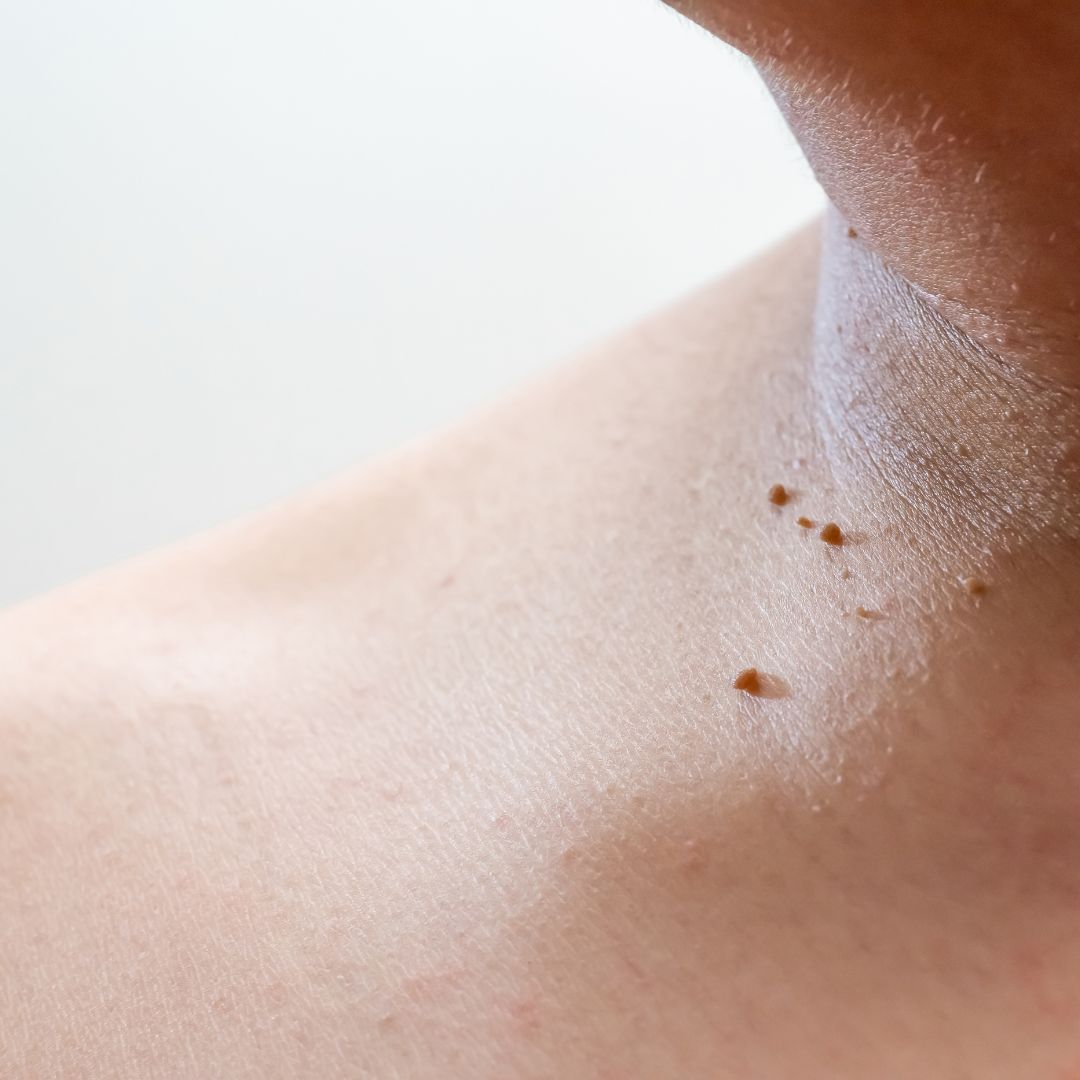 Skin tag removal Bangkok at BAC Clinic using CO2 laser