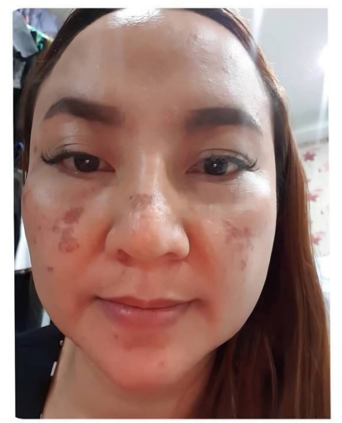 Before Program Pico Melasma Klear at BAC Clinic Bangkok