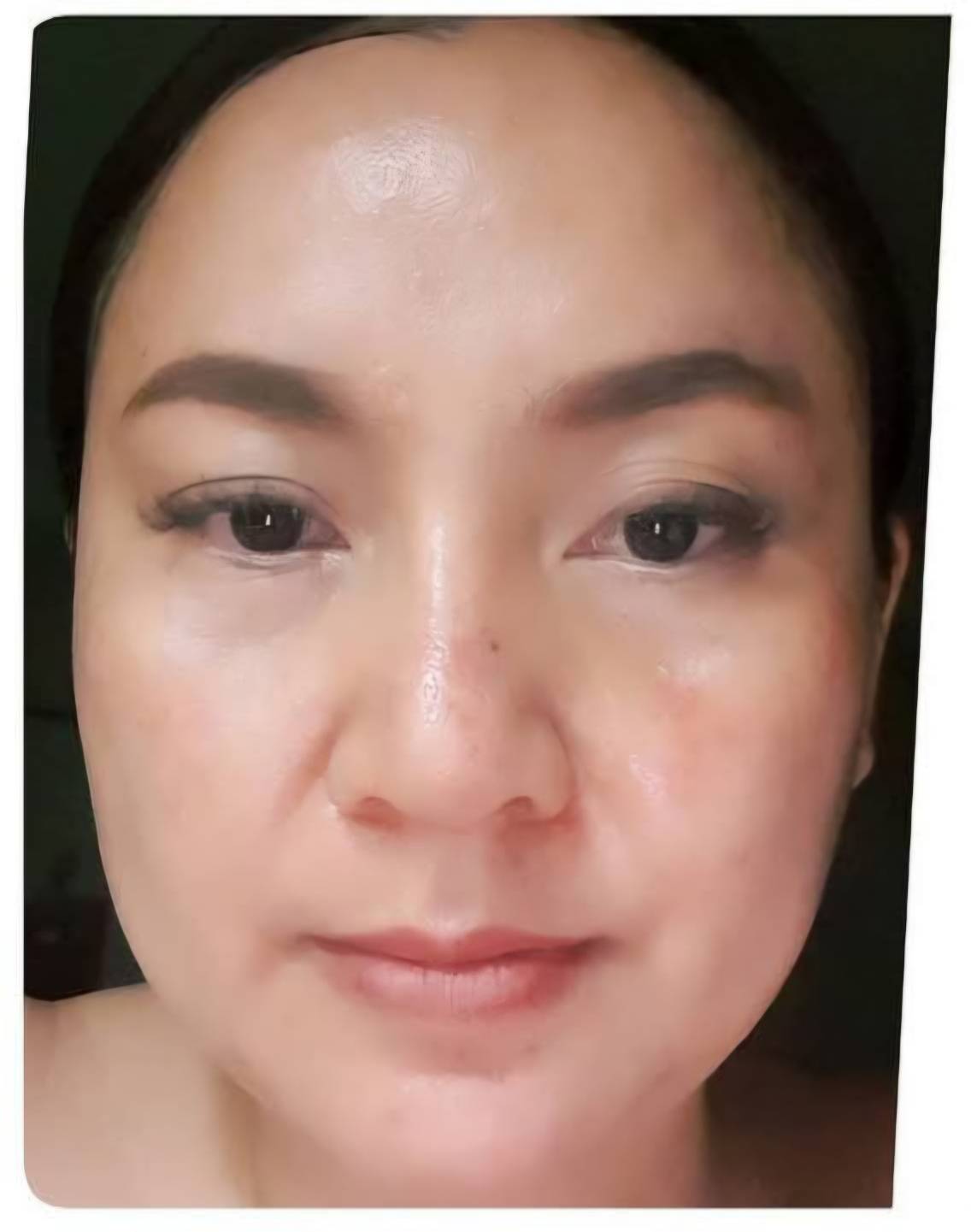 After Program Pico Melasma Klear at BAC Clinic Bangkok