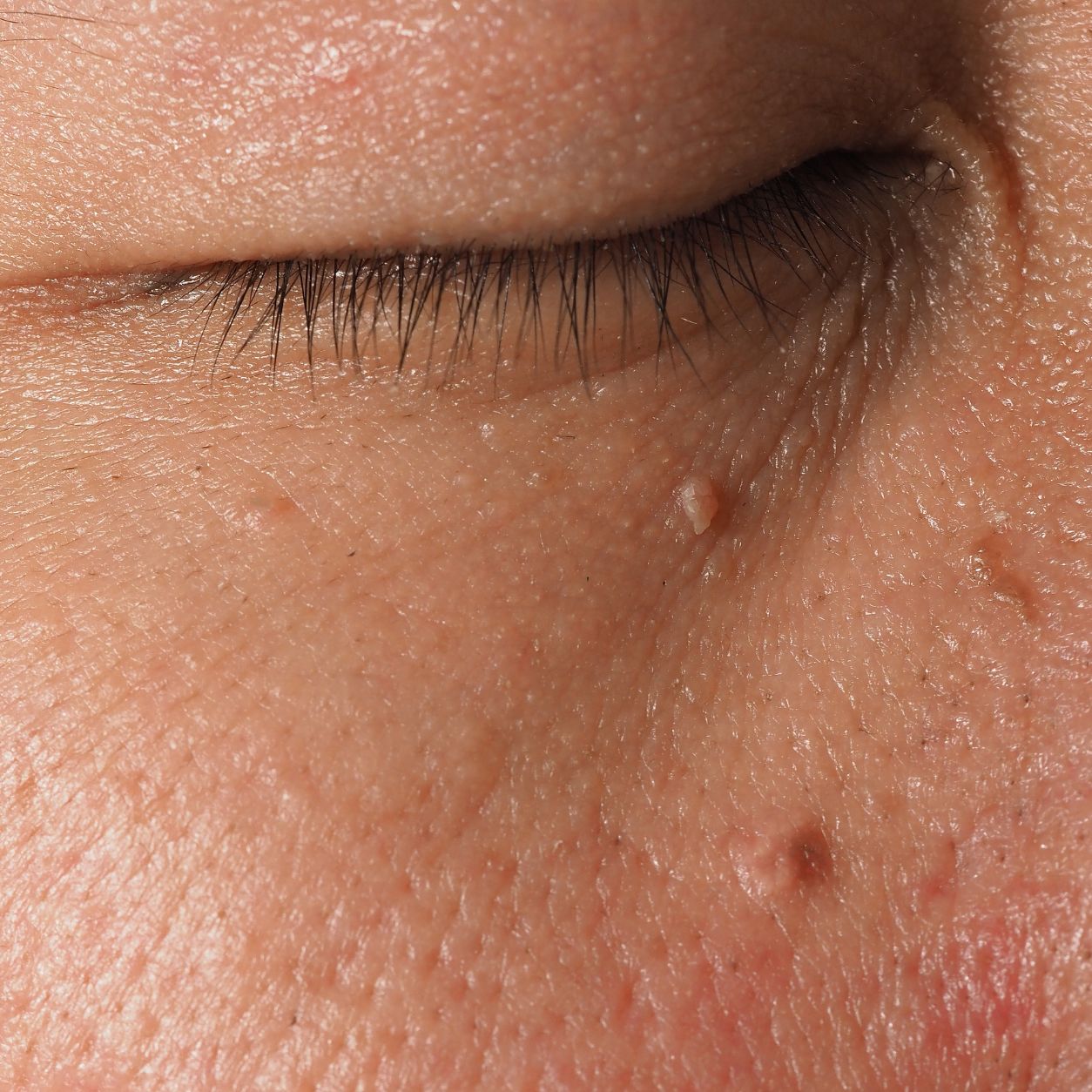 Example of benign skin tag before removal Bangkok