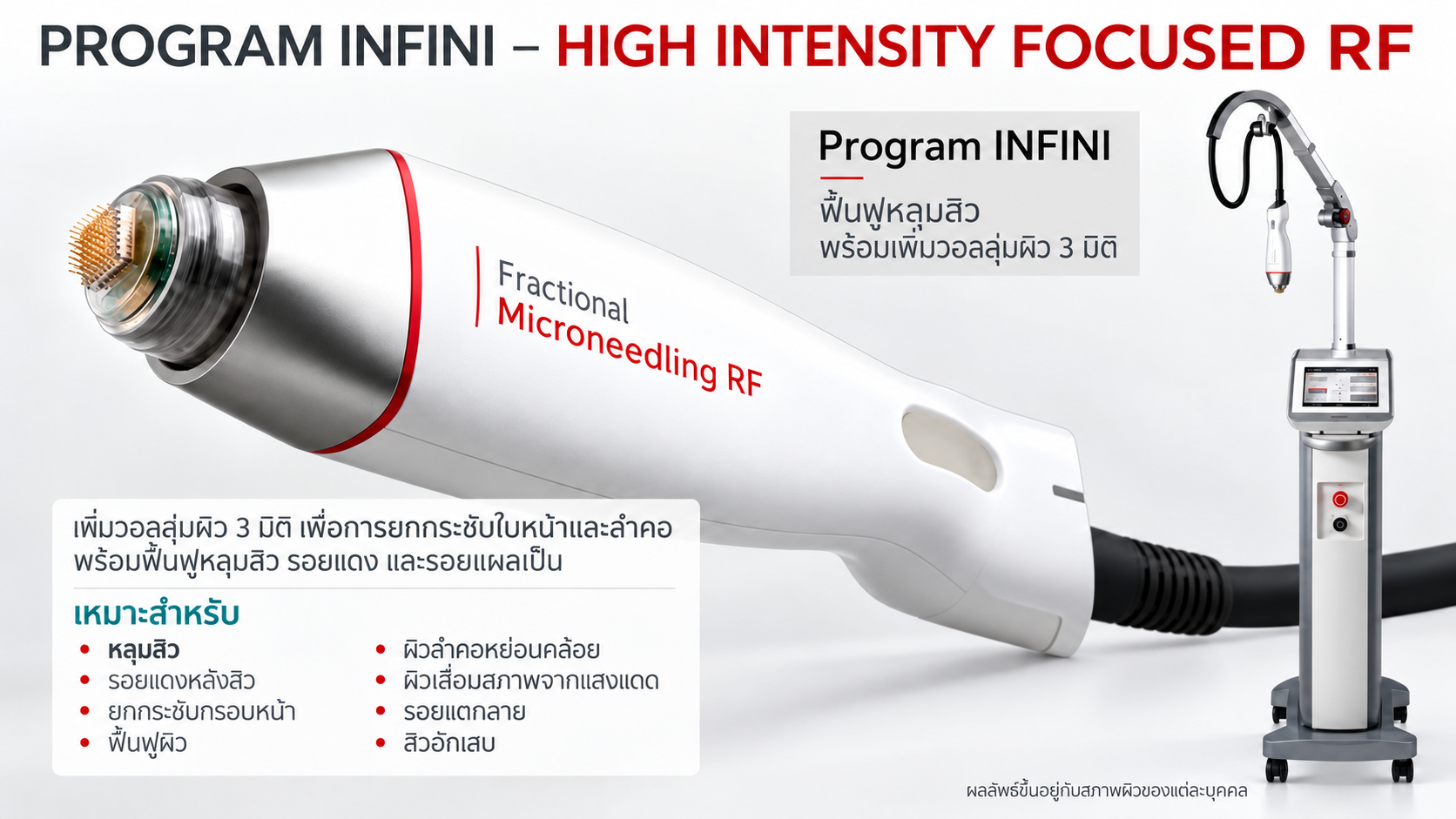 Program INFINI Fractional Microneedle RF สำหรับรักษาหลุมสิวและฟื้นฟู Dermis ชั้นหนังแท้ที่ BAC Clinic Bangkok