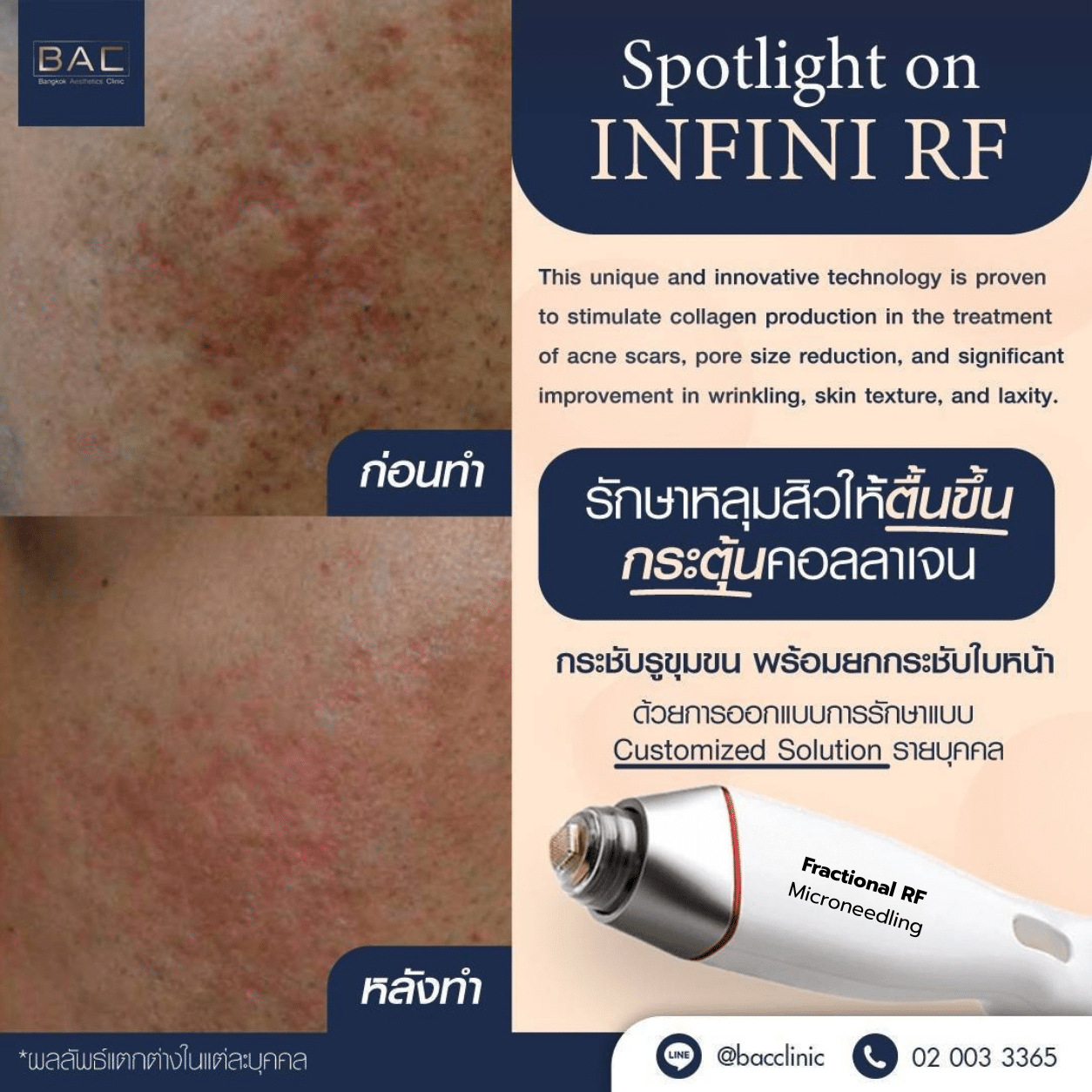 Before and after INFINI Fractional RF Microneedling acne scar treatment at BAC Clinic Bangkok