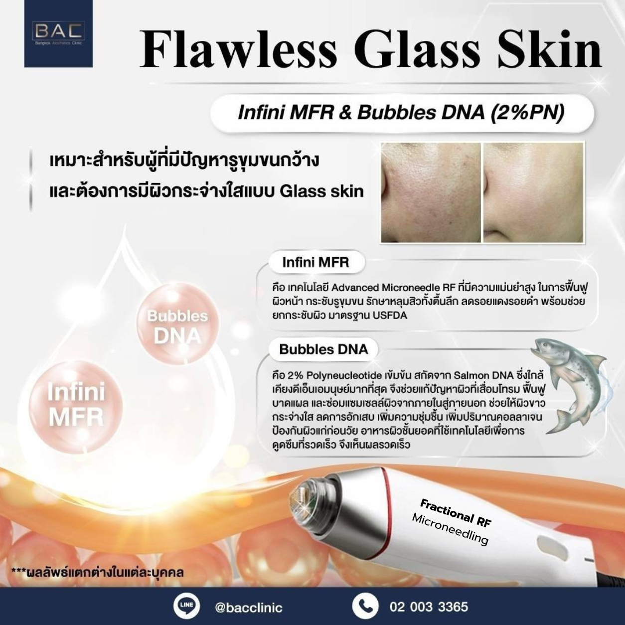 Customized INFINI Fractional RF Microneedling treatment for acne scars at BAC Clinic Bangkok