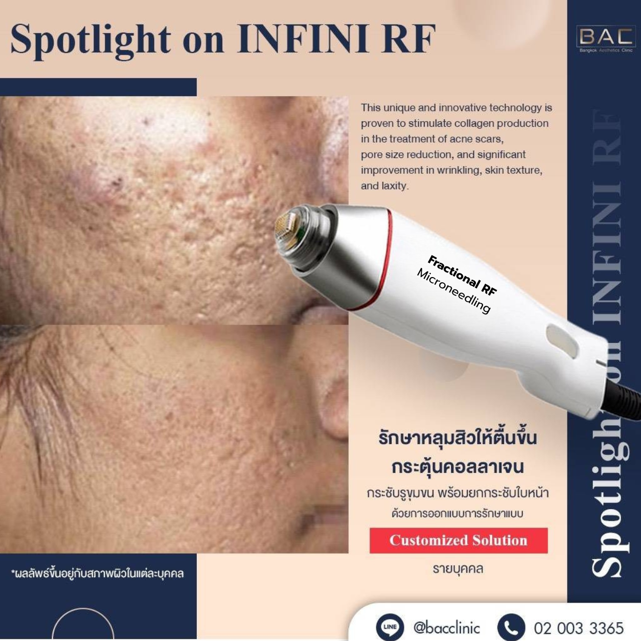 INFINI RF Microneedling technology for collagen remodeling and acne scar improvement in Bangkok