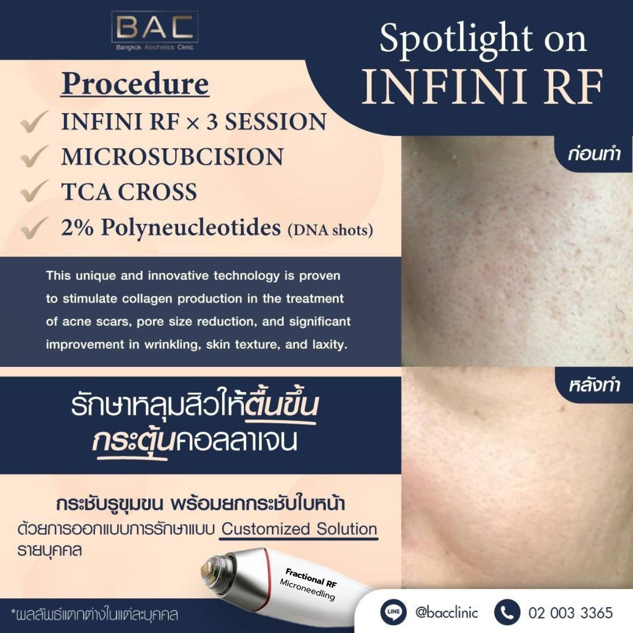 Fractional RF Microneedling program for acne scars enlarged pores and uneven skin texture