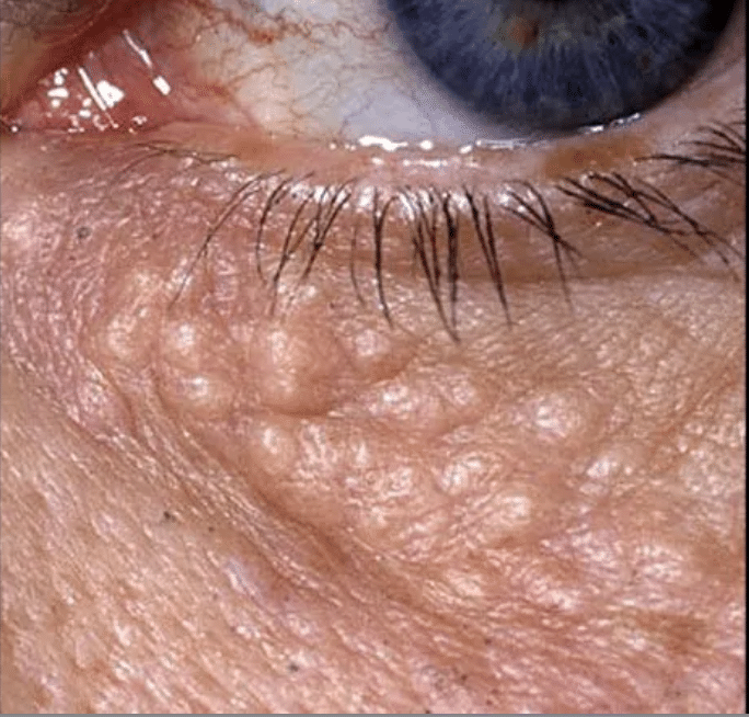 สิวหิน Syringoma ลักษณะเป็นตุ่มเล็กหลายเม็ดบริเวณใต้ตาและรอบดวงตา